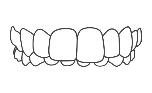 Overbite