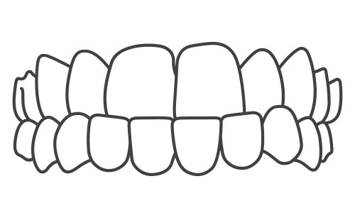 Underbite