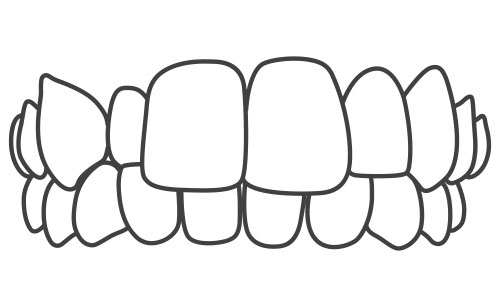 Crossbite