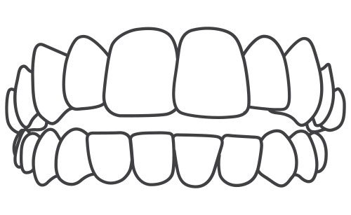 Open Bite 