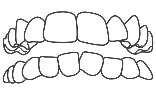 Crowded Teeth