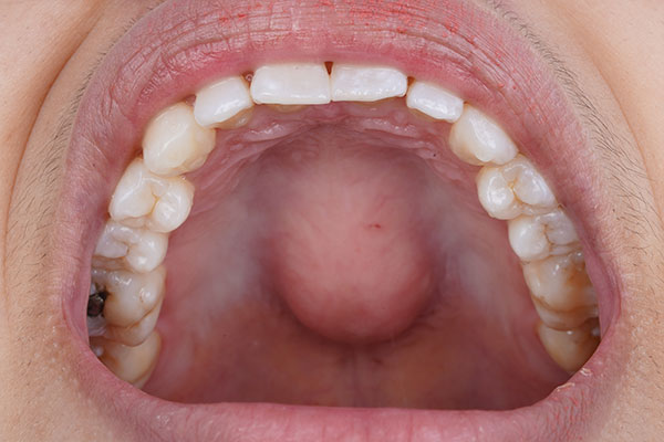 Top Teeth