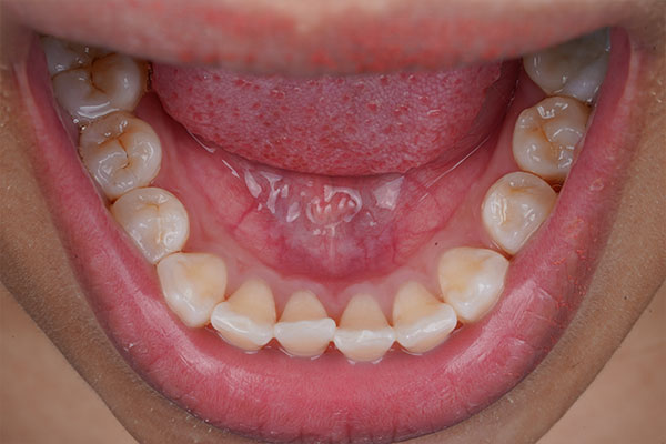 Bottom Teeth